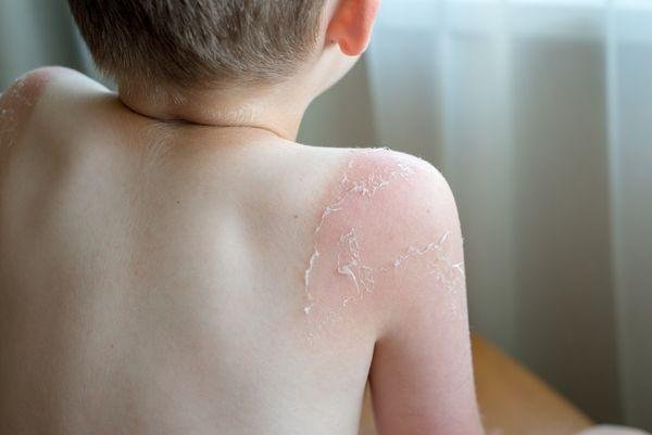 Câncer de pele também atinge crianças
