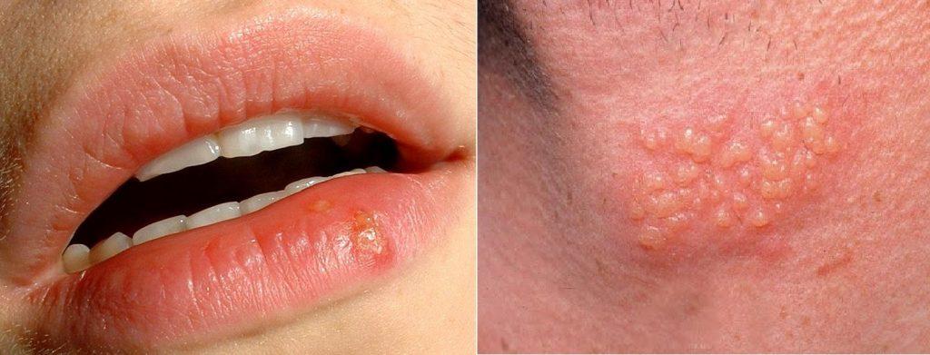 Herpes simples: o BBB Eliezer beijou a colega Natália com o vírus...