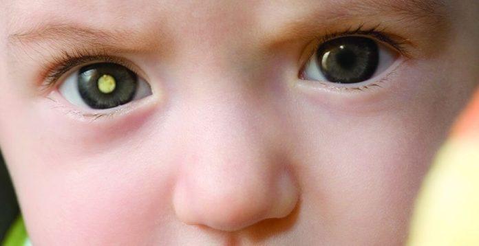 Retinoblastoma: câncer no olho de bebês pode ser detectado em fotos feitas...