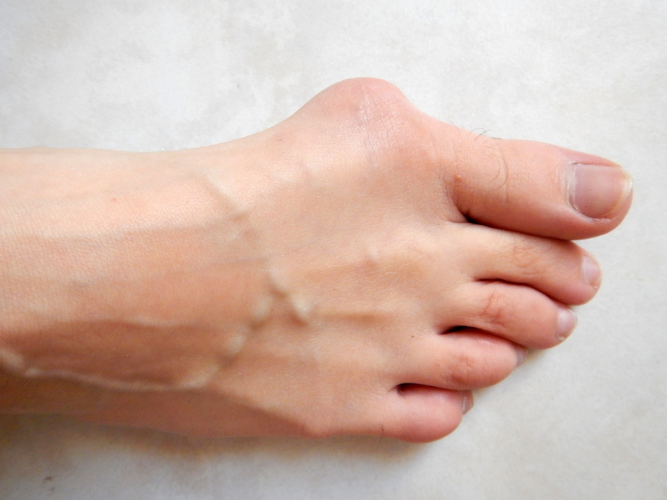 Joanete pode afetar até 30% das mulheres na fase adulta da vida