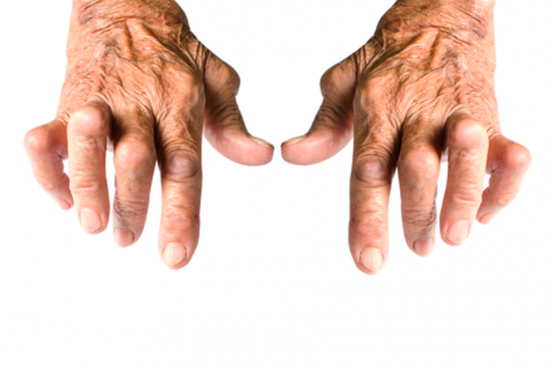 Artrite Reumatoide: doença crônica, que provoca rigidez matinal e dores nas articulações...