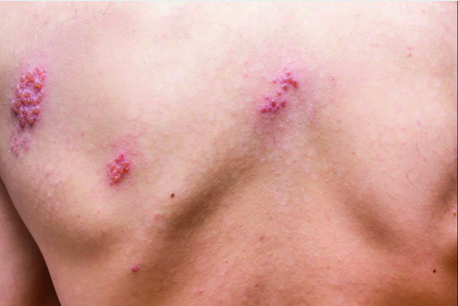 Herpes zóster: uma doença difícil, mas que tem tratamento e conta com...