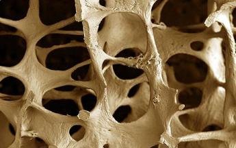 Número de casos de osteoporose e osteopenia deve triplicar até...