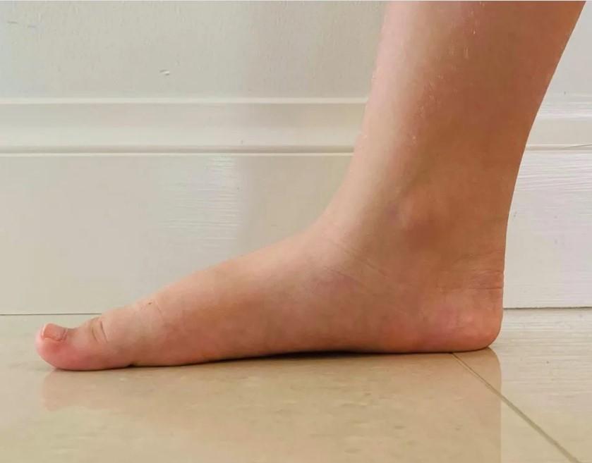 Pé chato em crianças a partir dos 7 anos deve ser avaliado...