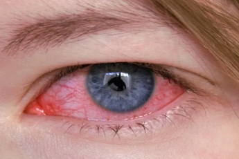Vermelhidão nos olhos é o principal motivo de urgências oftalmológicas,...