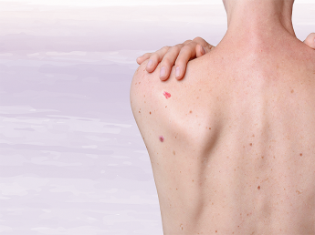 Câncer de pele: saiba como identificar os sinais e agir...