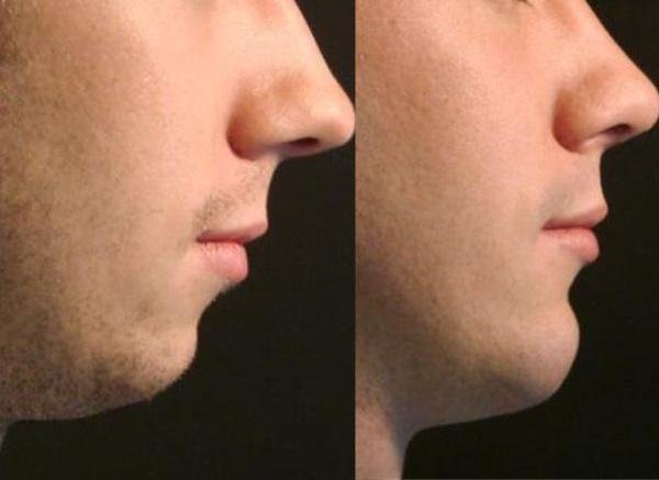 Cirurgia no queixo pode melhorar o nariz; entenda