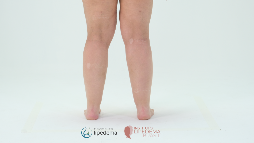 Portadoras de lipedema podem usar suplementos?