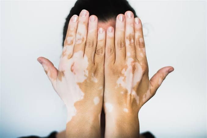 Vitiligo: uma condição de pele com impactos que vão além...