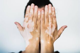 Vitiligo: uma condição de pele com impactos que vão além do físico - capa